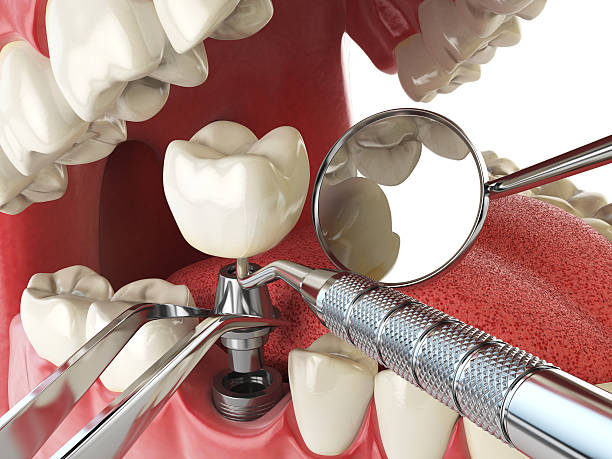 Best Urgent Care for Lost Fillings or Crowns in Sidney, IL